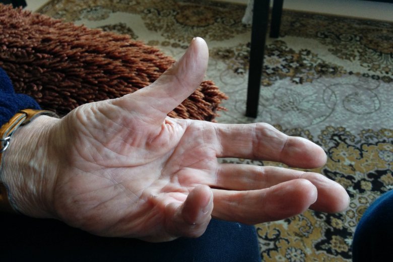 La caracteristica principala de la malautiá es que los dets de la man se crispan de biais natural