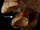 Los neandertalians emplegavan de curadents per calmar la malautiá parodontala